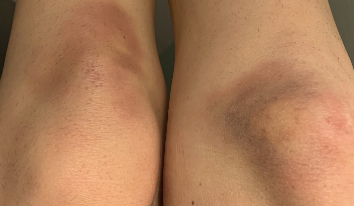 photo of bruised knees